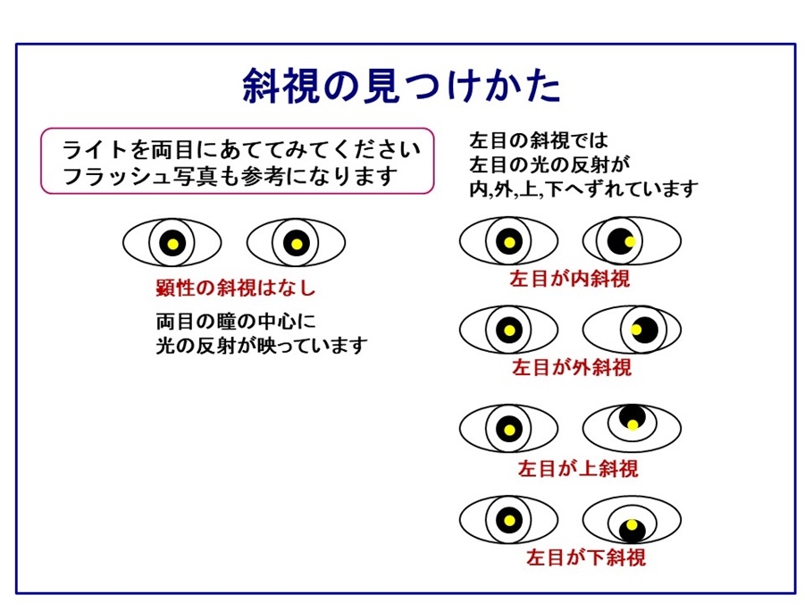 斜視の見つけかた