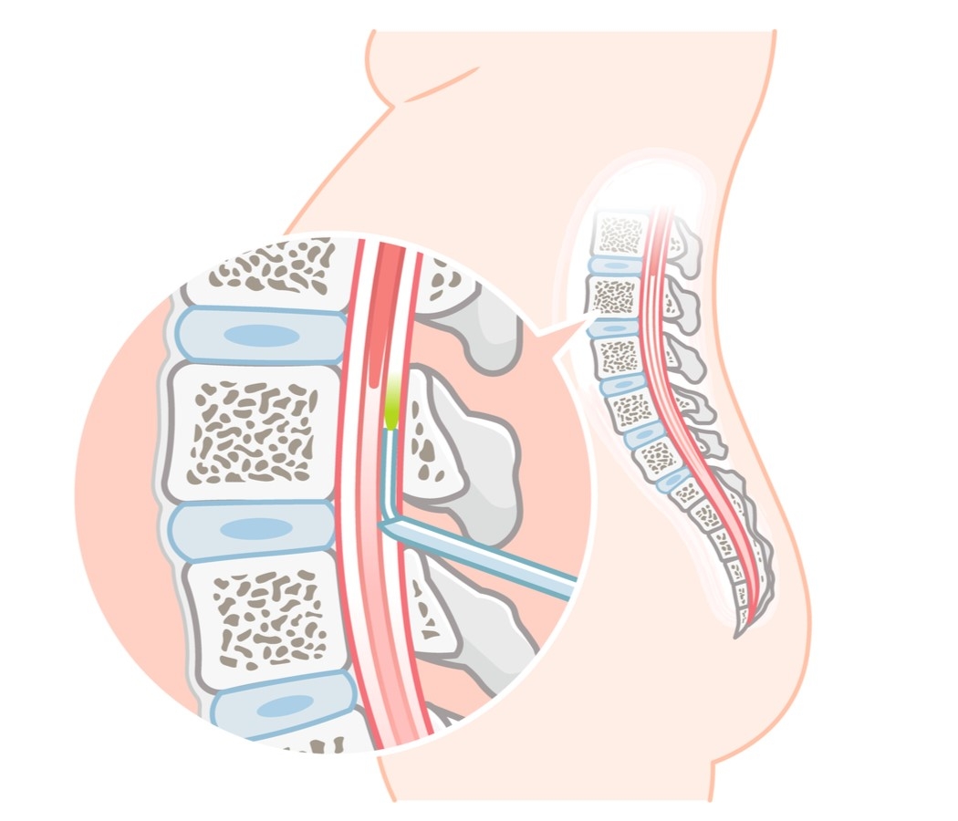 脊髄と脊髄液を包んでいる硬膜の外側にある硬膜外腔に1mm弱の細い管（カテーテル）を留置